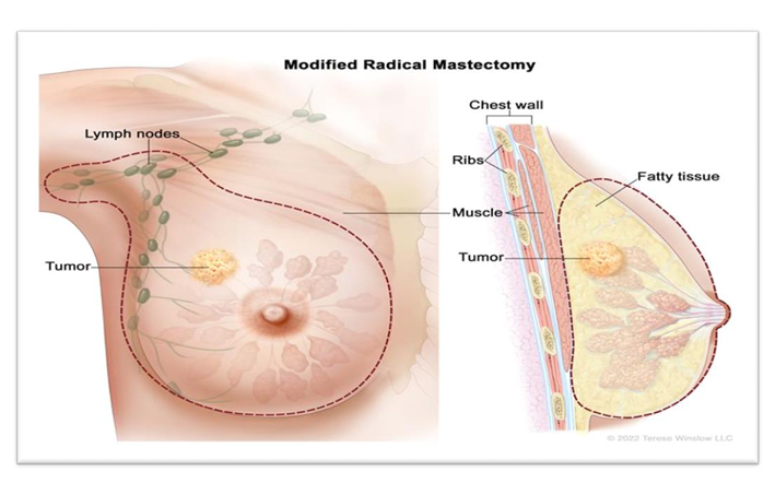Breast cancer diagram showing tumor and chest wall (modified radical mastectomy)