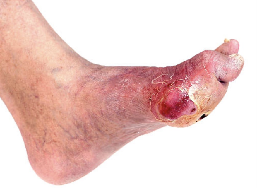 Leg infection treatment setup